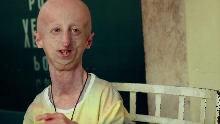 Leben mit Progerie: Unheilbar krank und doch so glücklich  Sammy Basso hat seine Lebenserwartung fast verdoppelt 