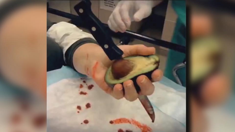 Autsch! Passen Sie auf beim Avocado-Schneiden Ärzte warnen vor 'Avocado-Hand'