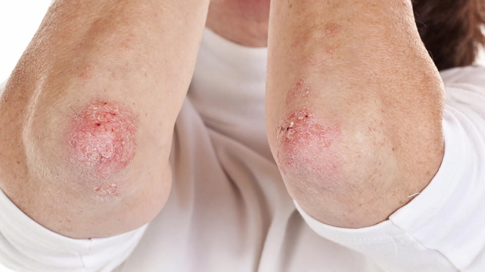Alle Fakten rund um Schuppenflechte Diagnose Psoriasis - wenn die Haut streikt