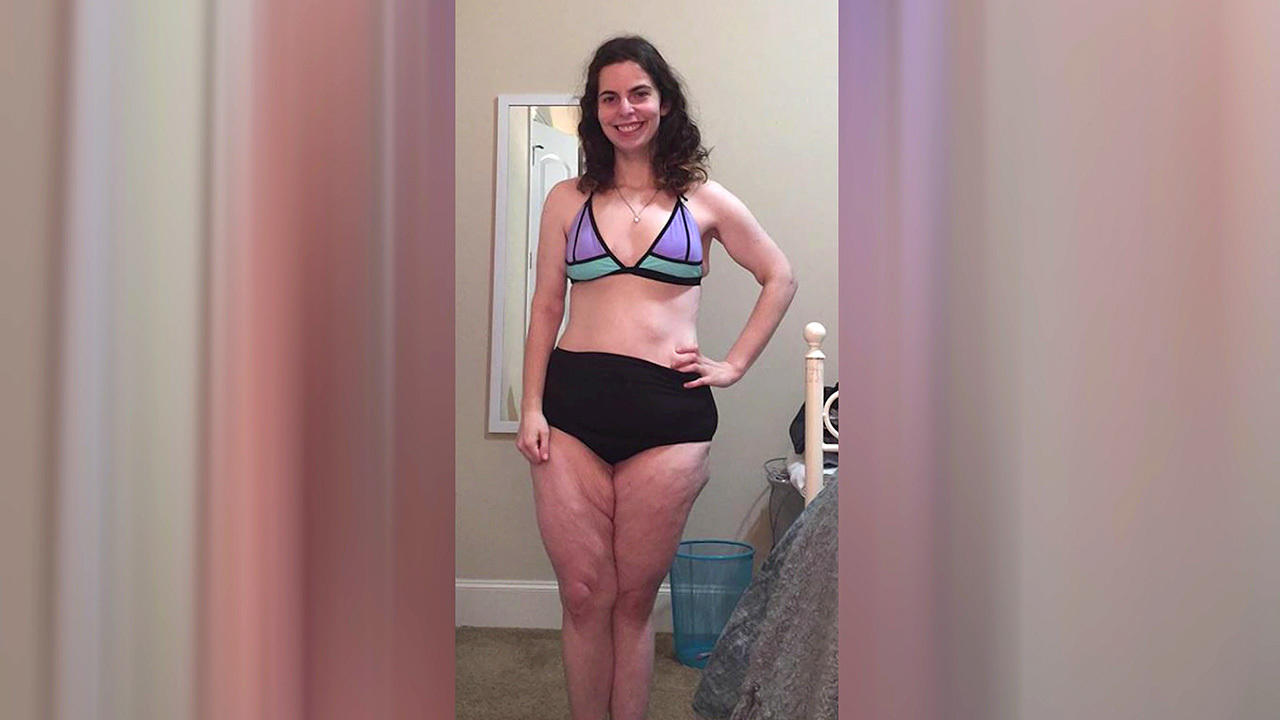 Ein Bikinifoto geht um die Welt Lesley Miller trägt stolz mit 21 ihren ersten Bikini