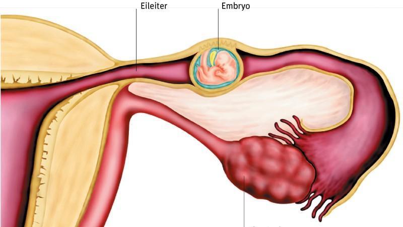 Eileiterschwangerschaft: Symptome und Behandlung Schwangerschaft außerhalb des Uterus