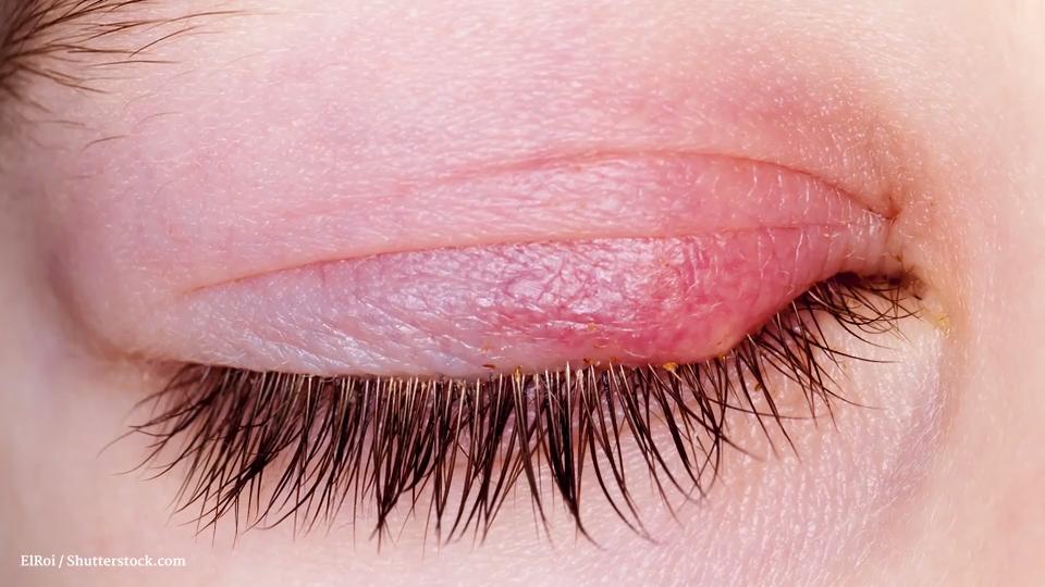 Gerstenkorn: So wird man es schnell los Lästige Augenentzündung