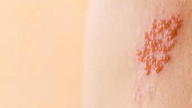 Was ist eine Gürtelrose? Windpocken-Virus löst Herpes Zoster aus