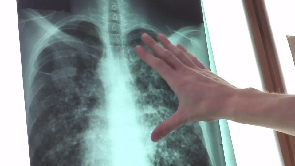 Was ist eine Lungenfibrose? Erkrankung der Lunge