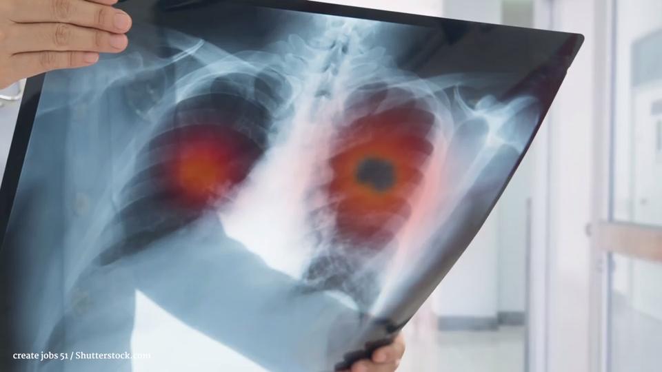 Lungenkrebs: Ursachen und Symptome Tumor in der Lunge