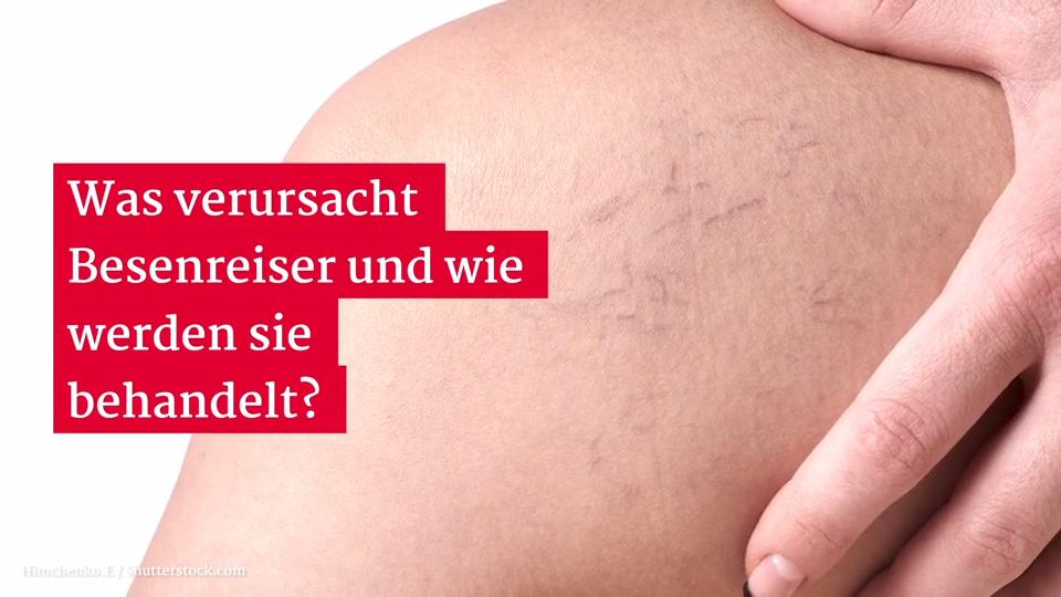 Besenreiser: Ursachen und Behandlung Gesundheitslexikon