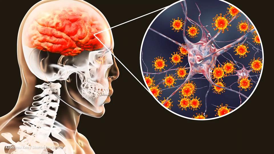 Enzephalitis: Wenn sich das Gehirn entzündet Gesundheitslexikon