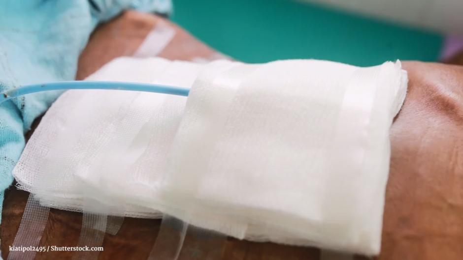 Was Ist Eine Drainage Medizin www.rtl.de