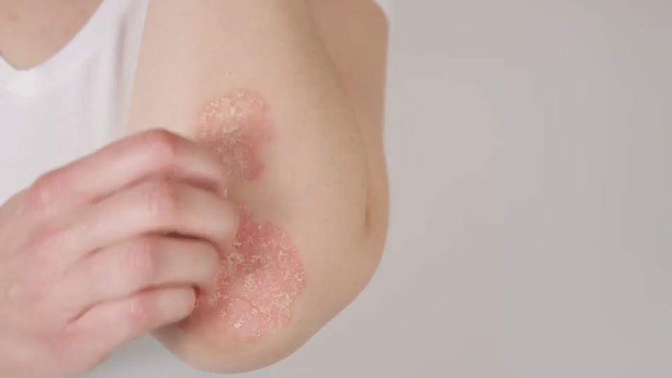 Hautkrankheiten: von heilbar bis lebensgefährlich Viele Formen und Ursachen