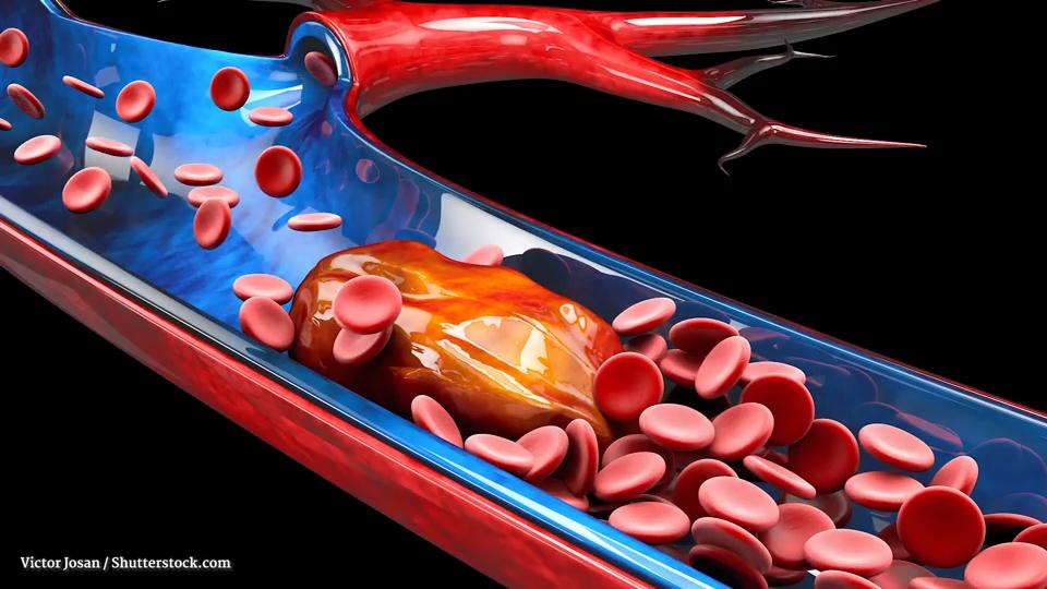 Heparin – Ein Blutverdünner Bei OP soll es Thrombose unterbinden