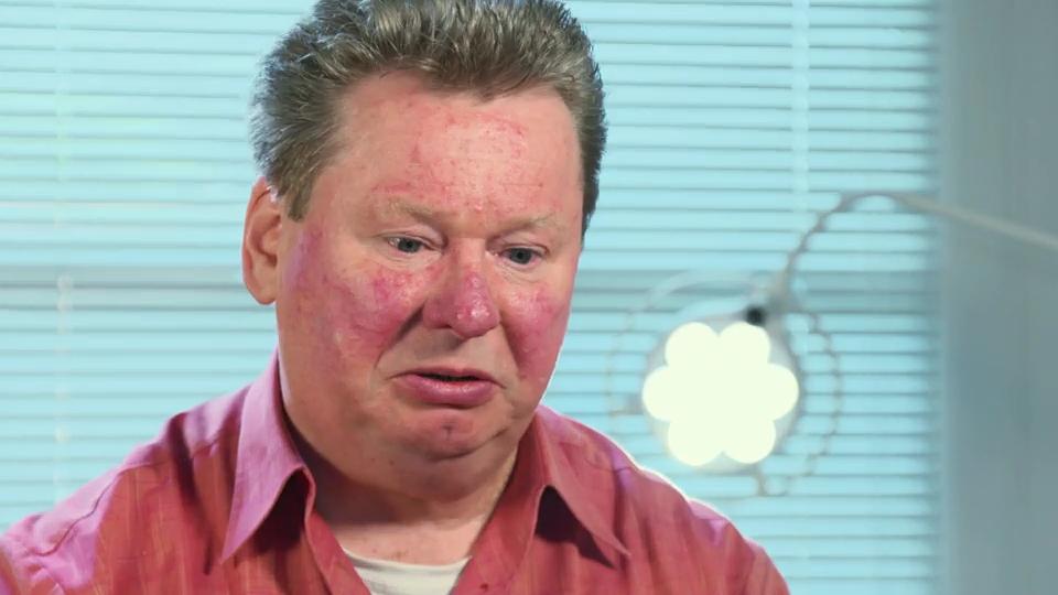 Johannes leidet unter Blicken anderer Rosazea-Behandlung