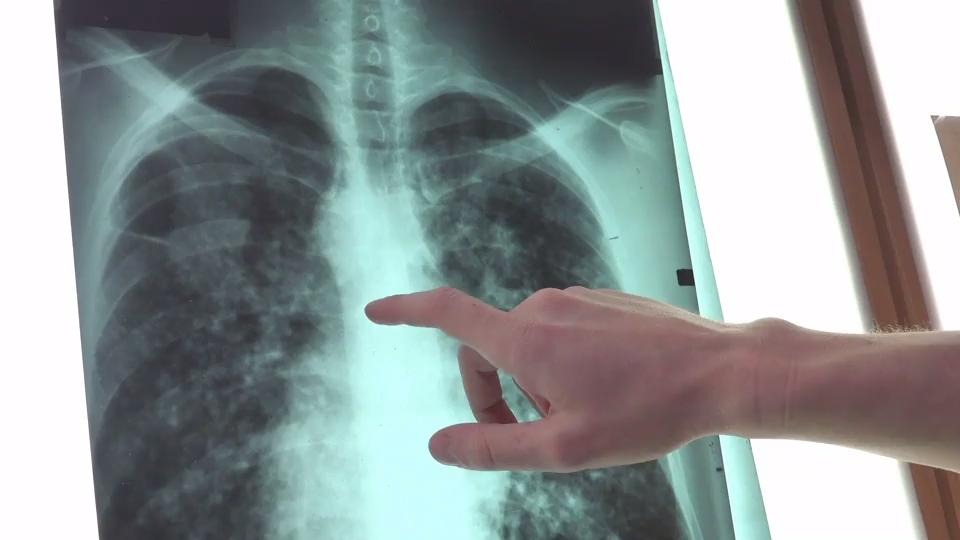 Kann sich die Lunge von einem Emphysem erholen? Gesundheitslexikon