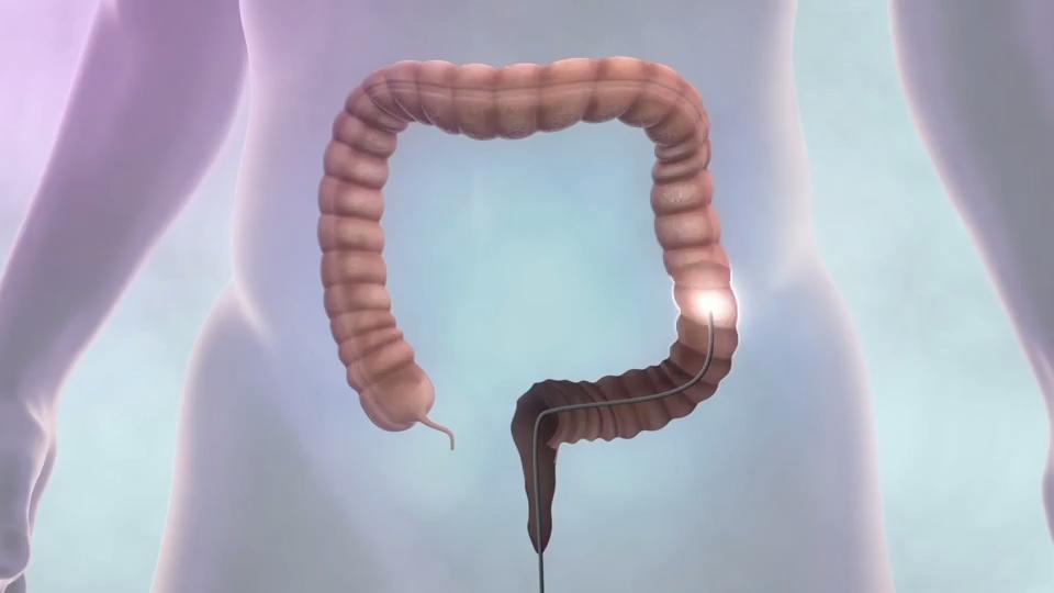Was ist eine Darmspiegelung? Gesundheitslexikon