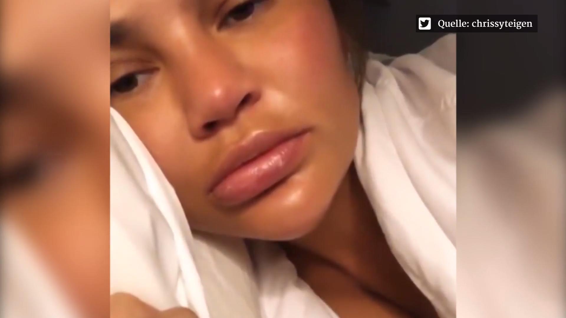 Chrissy Teigen comparte impactantes fotos en Fat Lips Alert