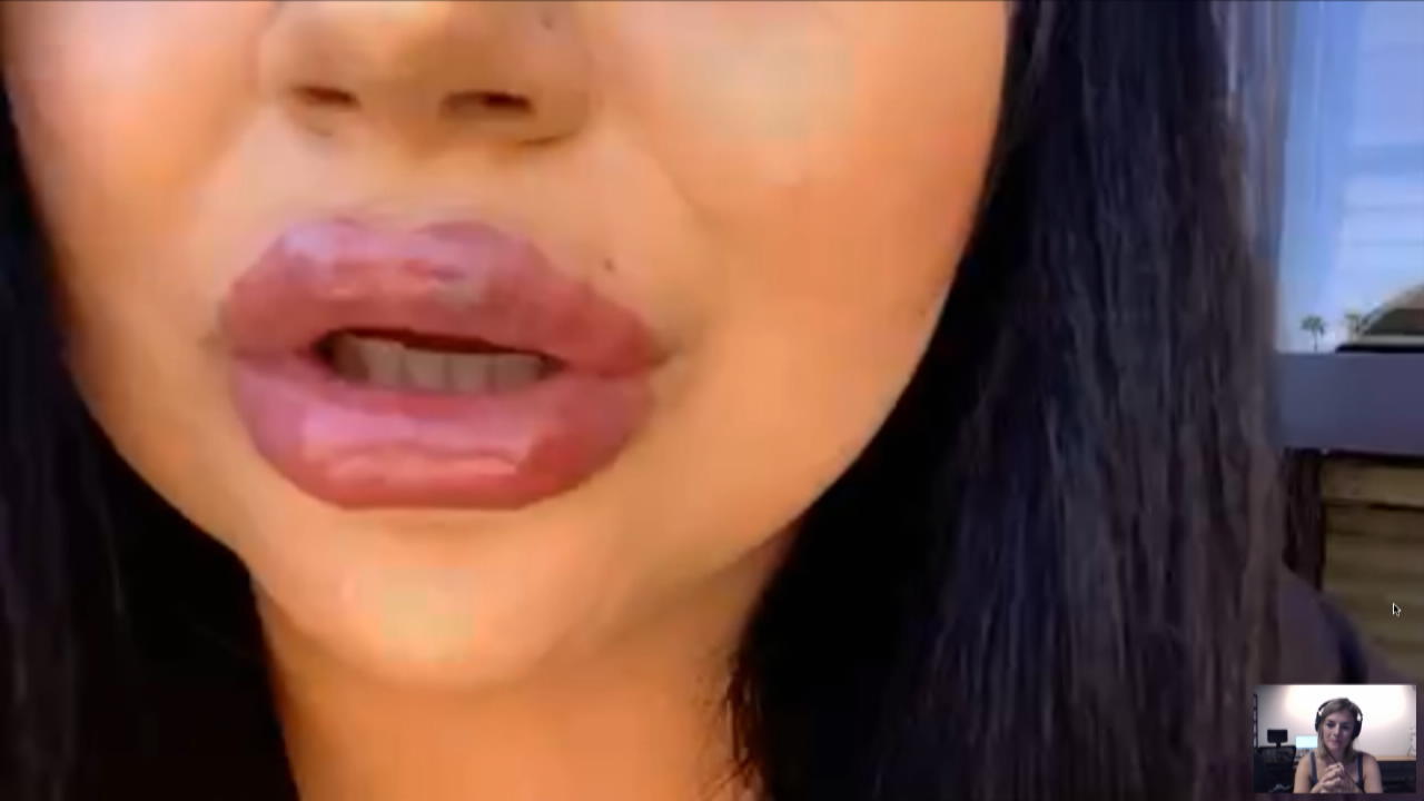 Schlauchboot-Lippen nach Lippenunterspritzung Schlimme Infektionen bei 7 Frauen