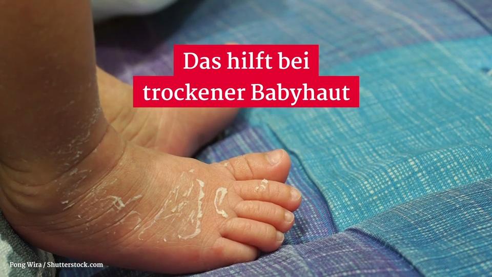 Trockene Haut beim Baby: Das hilft Jede Körperstelle kann betroffen sein