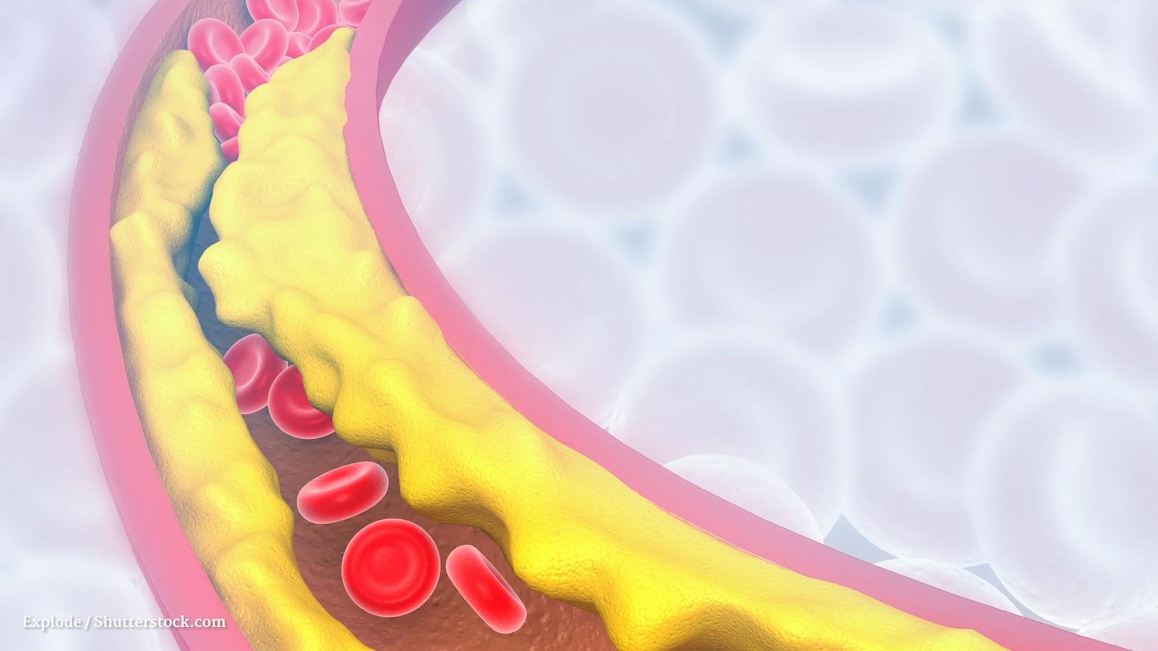 Was löst Hypercholesterinämie aus? Erhöhter Cholesterinspiegel