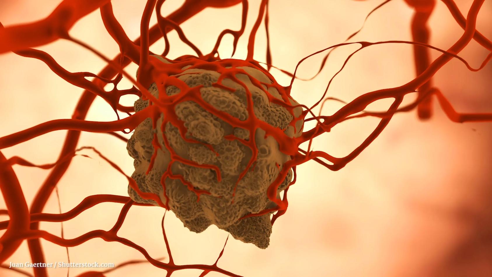 Tumore verstehen: die Grundlagen Gesundheitslexikon