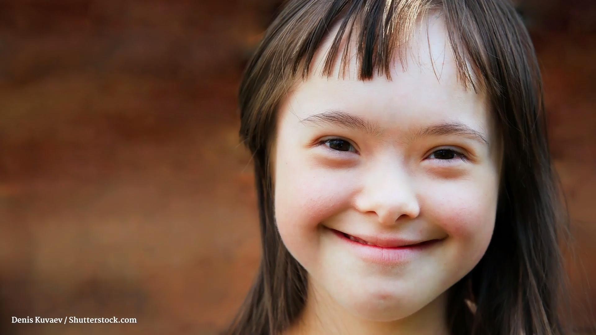 ¿Qué es el síndrome de Down?  Trisomía 21