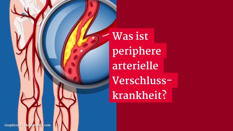Gesundheitslexikon: PAVK (periphere arterielle Verschlusskrankheit)