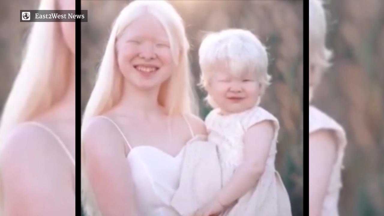 Albino Schwestern begeistern das Internet 