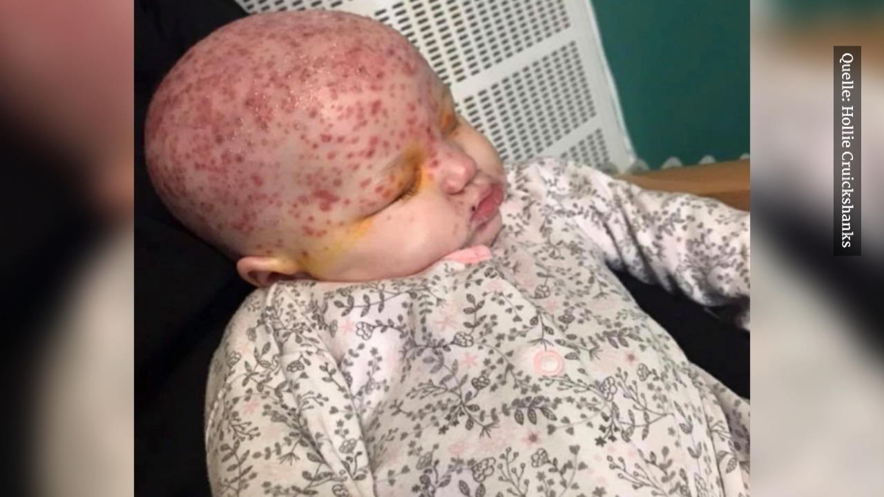 Baby hat Herpesinfektion am ganzen Körper Nach Kuss von Mutter fast erblindet