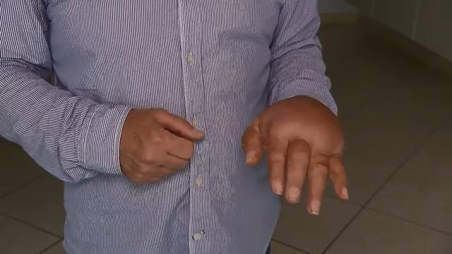Kölner hat extrem geschwollene Hand Nägel schneiden unter Vollnarkose