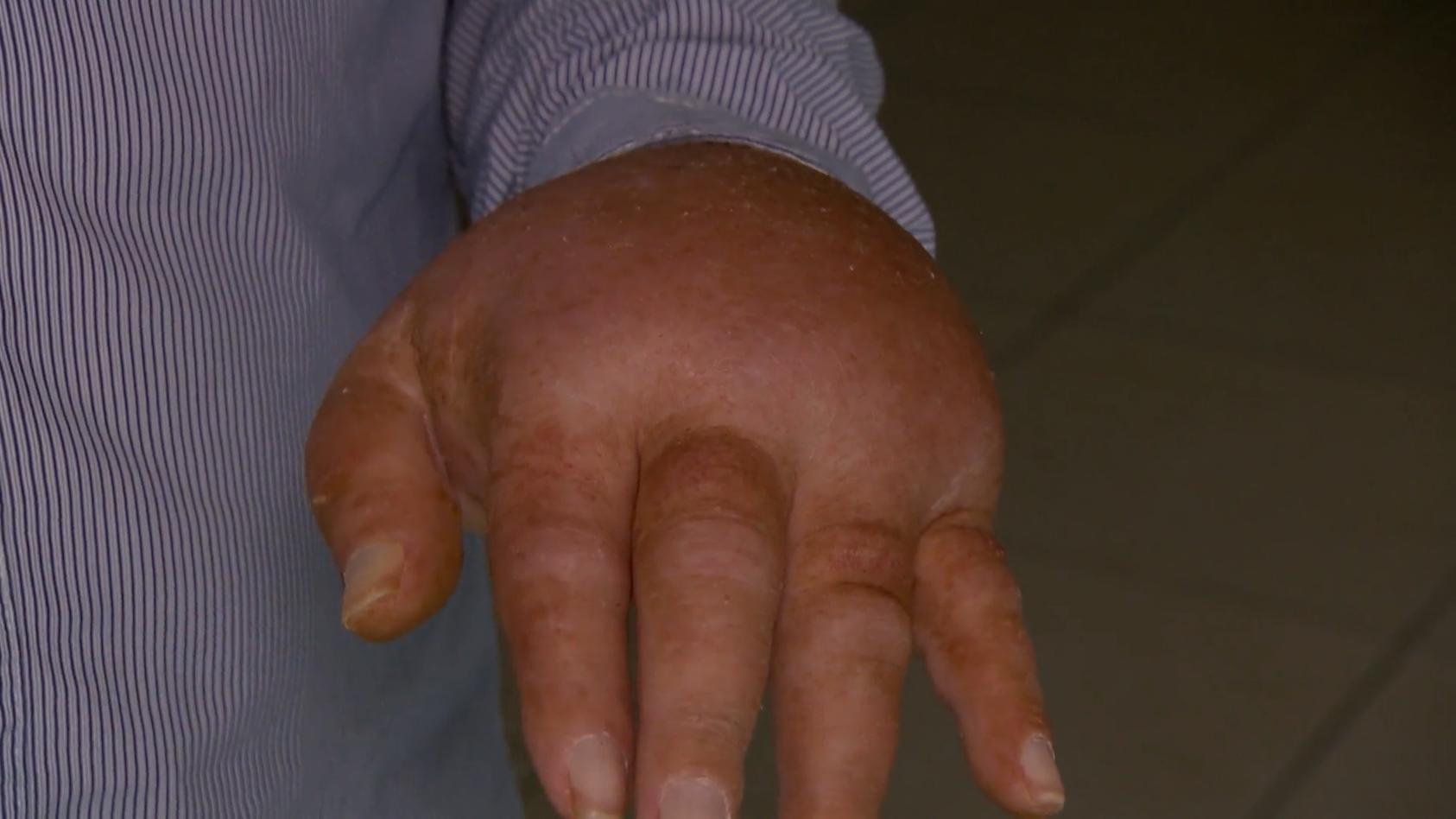 Mann (60) kriegt Nägel nur unter Vollnarkose geschnitten Seit einem Unfall hat Dieter K. grausame Schmerzen