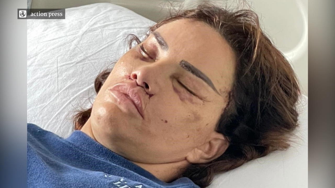 Katie Price zeigt ihr "neues" Gesicht nach OP Nach Horror-Schock-Foto