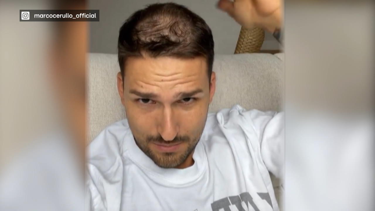Marco Cerullo erhält Haartransplantation Krasser Schritt