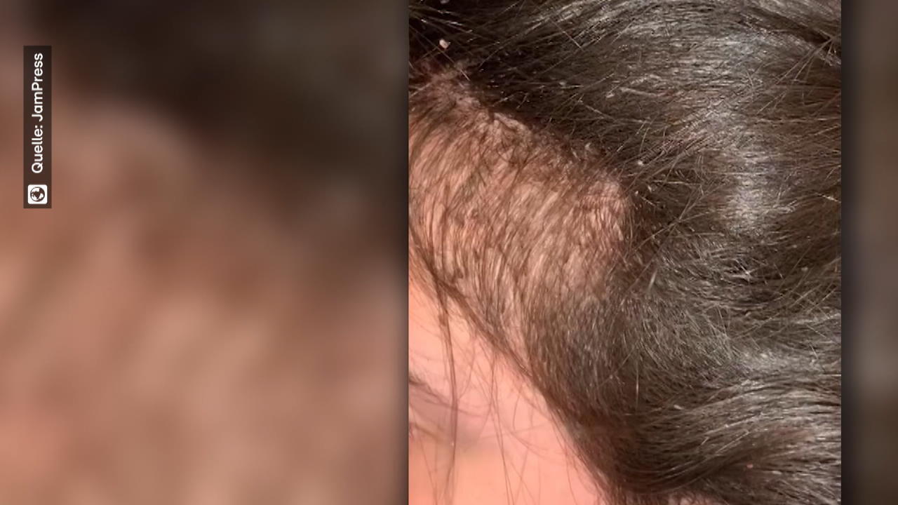 Plötzlich Schwarze Haare Auf Dem Kopf www.rtl.de