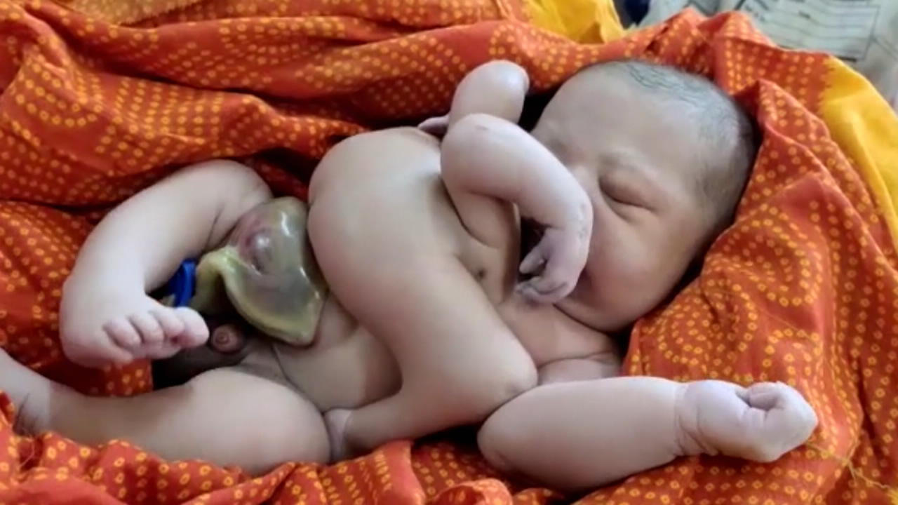 Kind mit 4 Armen und 4 Beinen in Indien geboren Baby wird als Gottheit gefeiert