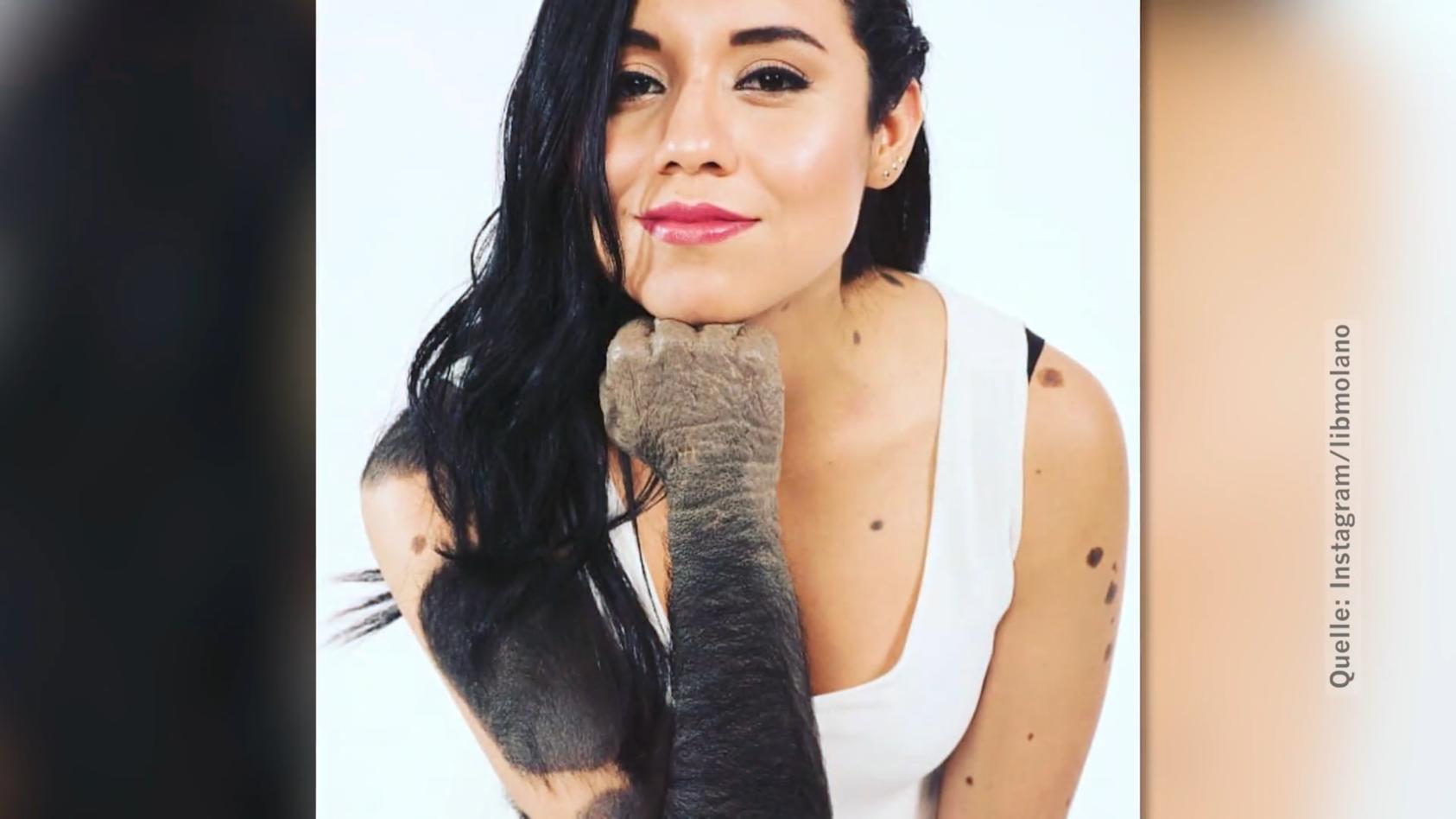 Libny Molano hat über 200 Muttermale Sie wird "Gorilla-Frau" genannt!