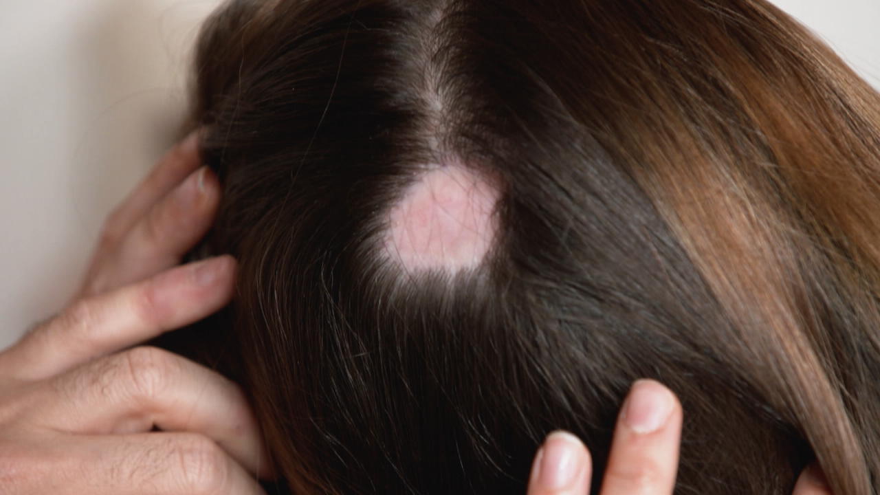 Quemaduras químicas en el cuero cabelludo después de visitar al peluquero ¿Pueden ayudar los RTL Beauty Rescuers?