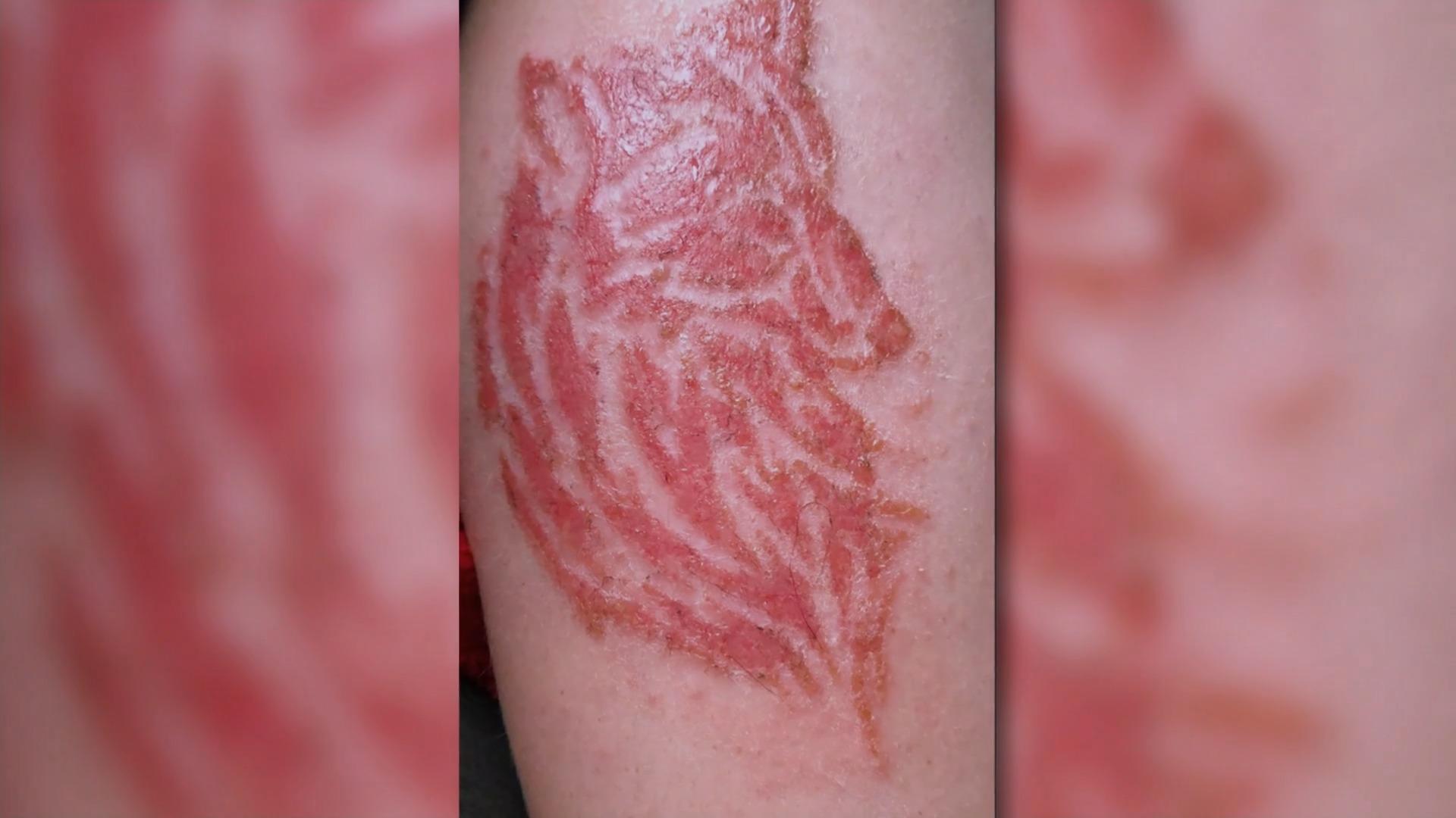 Haut-Horror nach Henna-Tattoo Schmerzhaftes Türkei-Souvenir