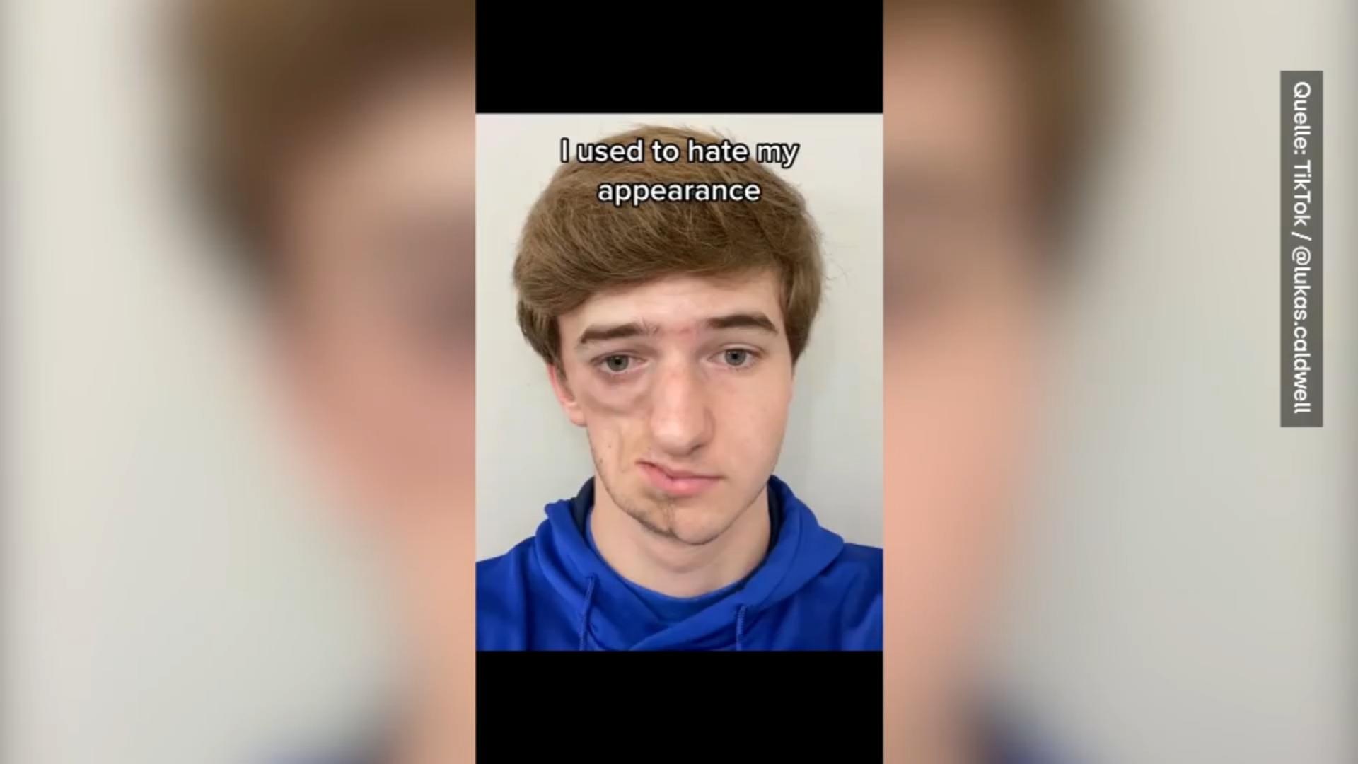 Lukas zeigt sein Leben mit Parry-Romberg-Syndrom Aufklärung über TikTok
