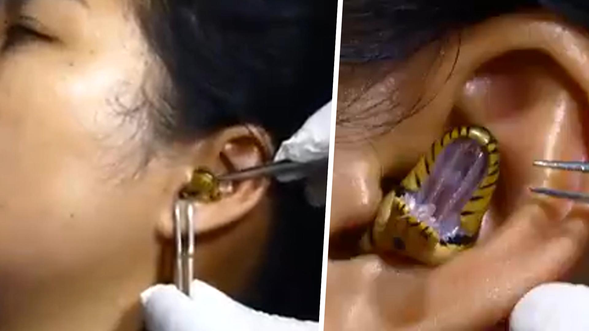 Frau geht mit Schlange im Ohr zum Arzt - kann das echt sein? Video sorgt für Aufsehen