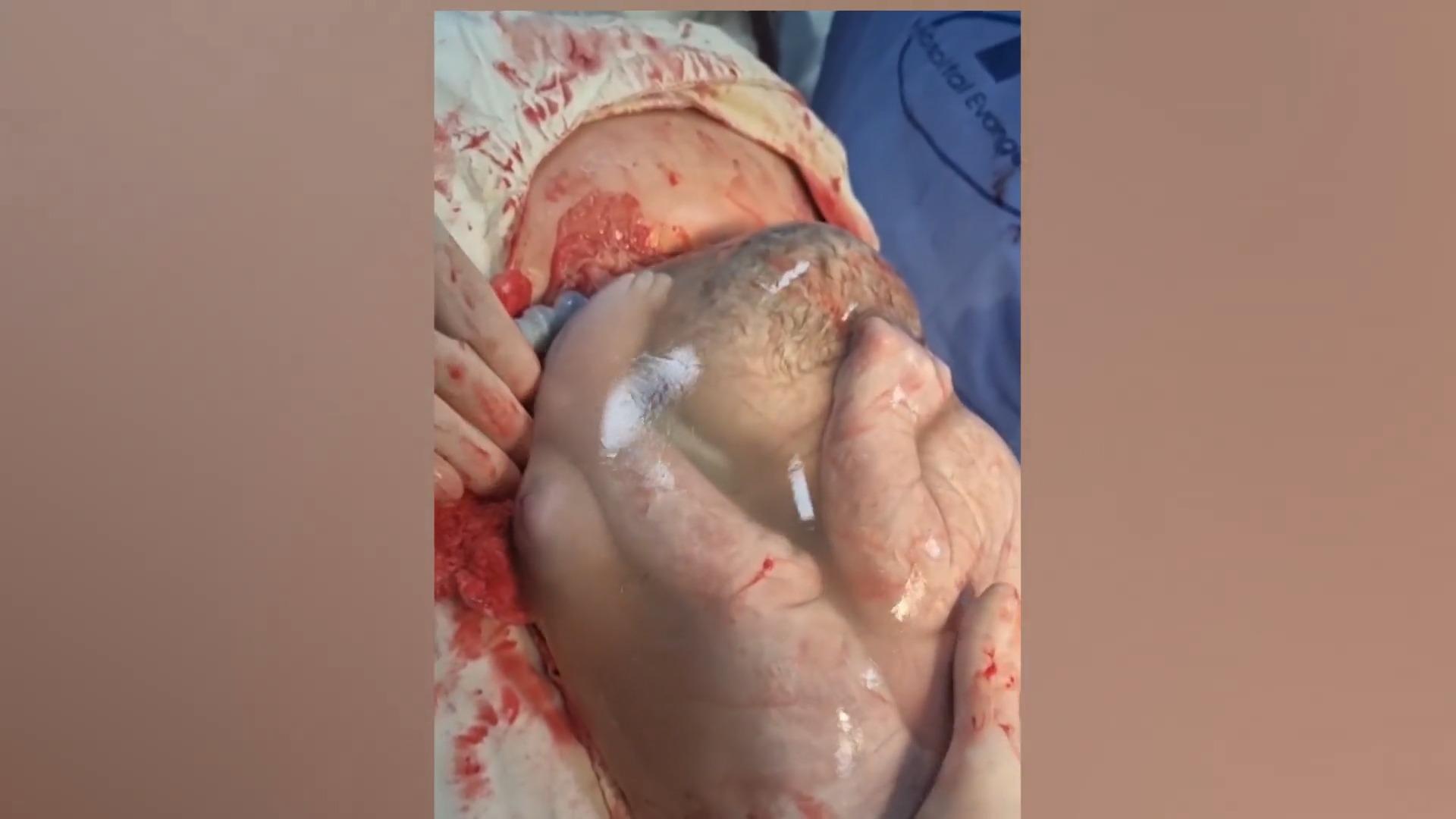 Geburt in der "Glückshaube" Baby kommt in intakter Fruchtblase zur Welt