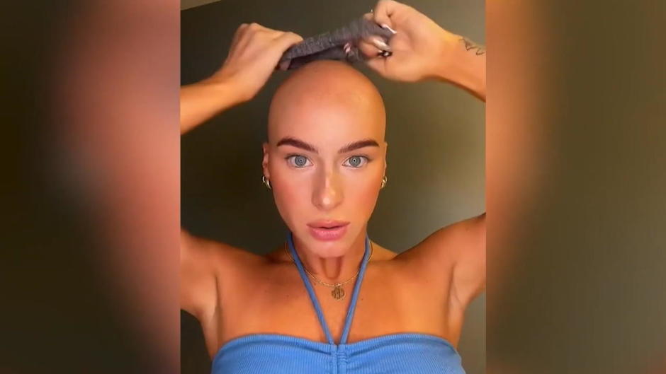 Früher wegen Alopecia gemobbt, heute Unternehmerin! Chloe Bean hilft