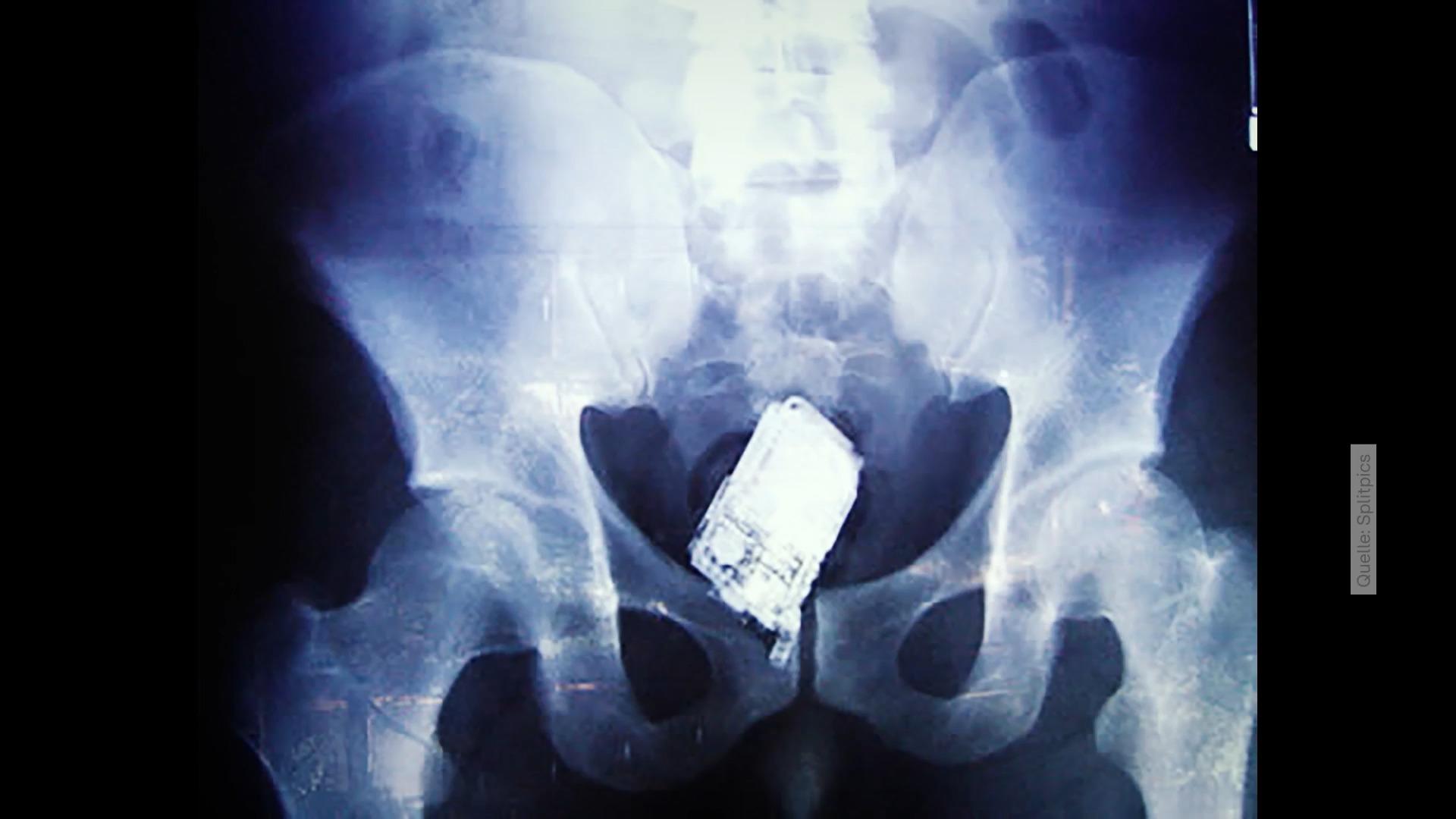 El médico analiza: ya lo encontraron en pacientes tras una granada en el culo