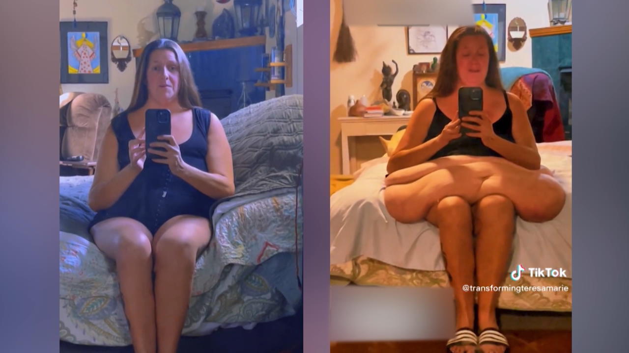Frau nimmt 160 Kilo ab - und ist verzweifelt! Mega-Verwandlung nach OP