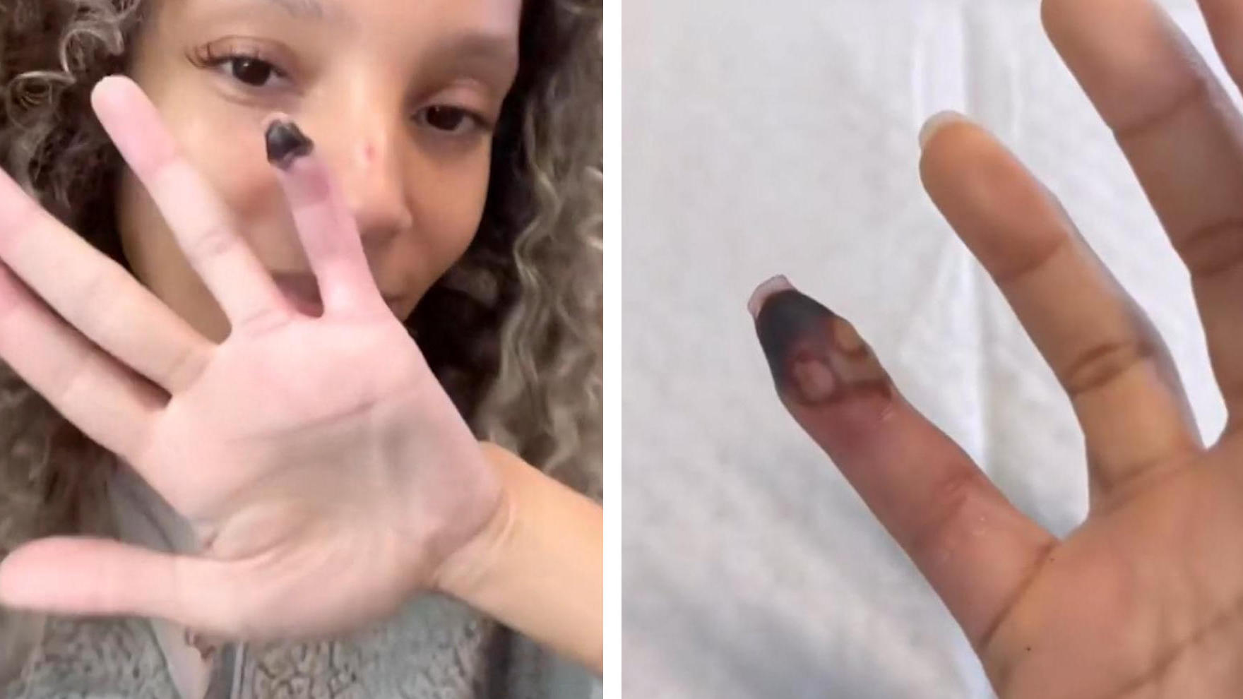 Frau klebt abgebrochenen Nagel an - dann stirbt Finger ab Mit Sekundenkleber?!