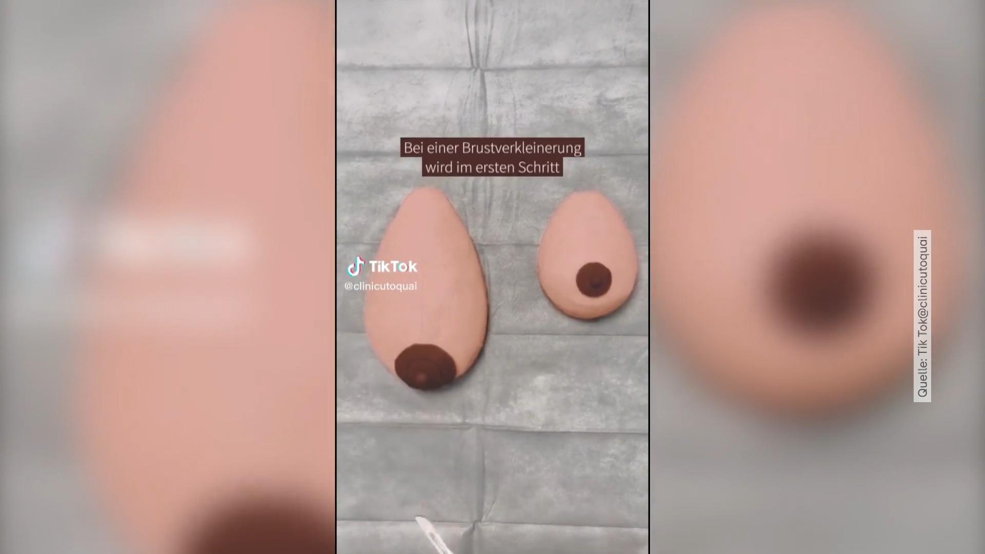 Hier wird eine Brust kleiner "geknetet" Medizinvideo geht viral