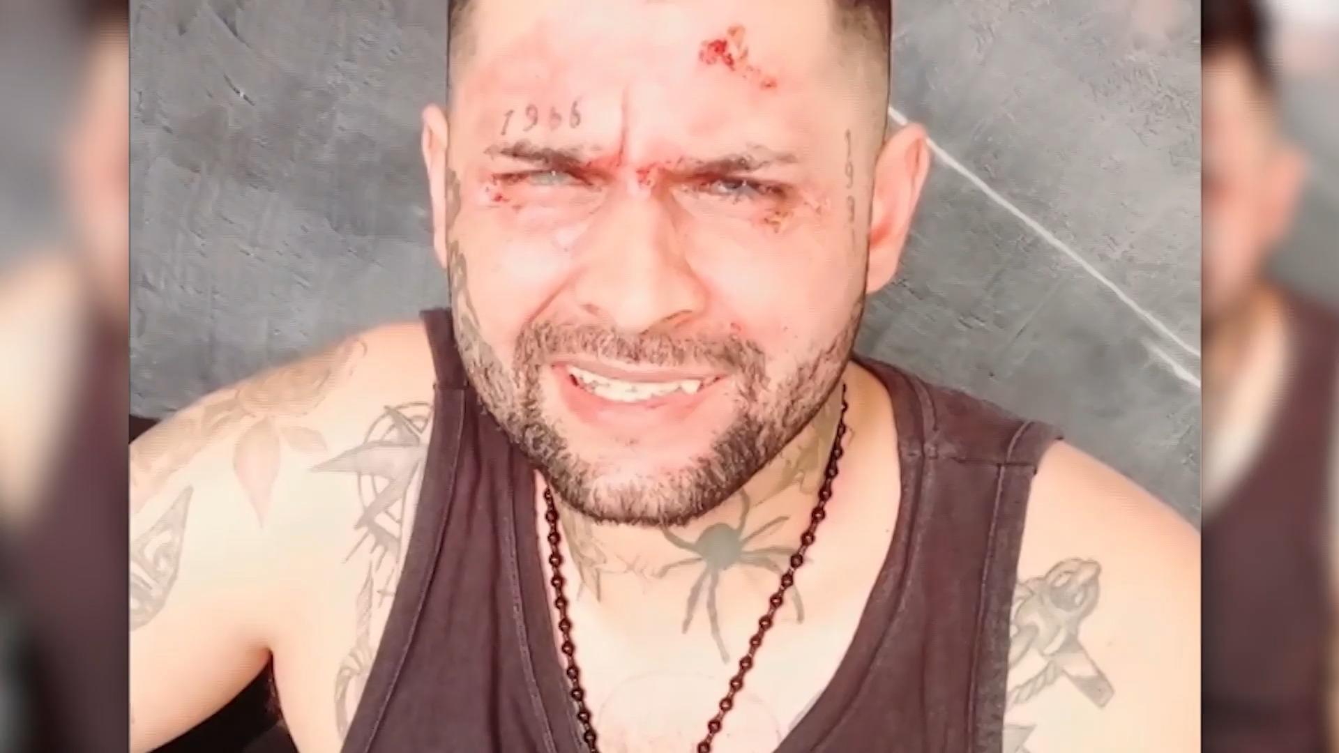 Tatuador atacado con ácido por su exesposa