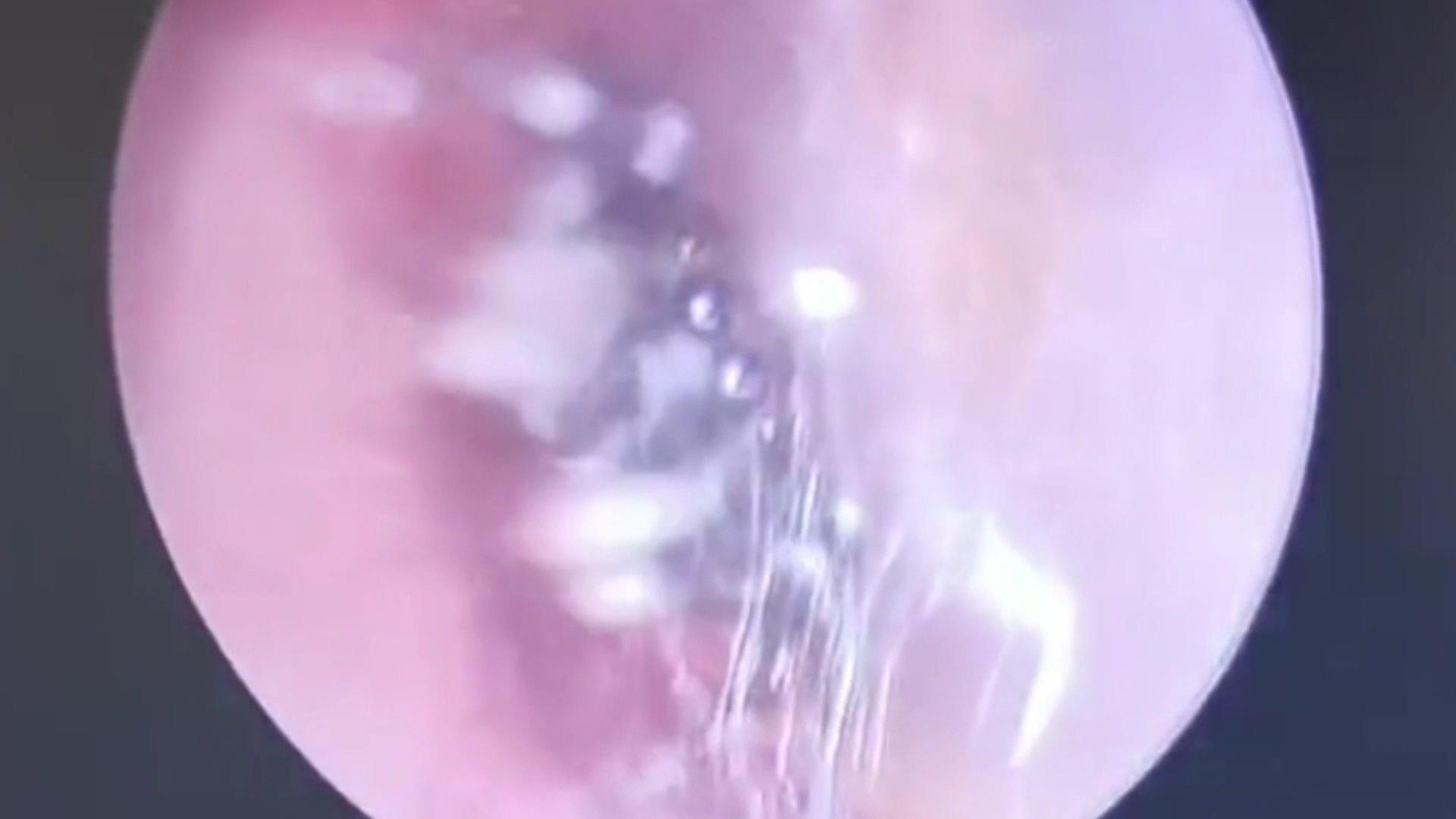 Ekel-Fund im Ohr: Arzt fischt Spinne aus Gehörgang! Wie kam die denn da hin?!