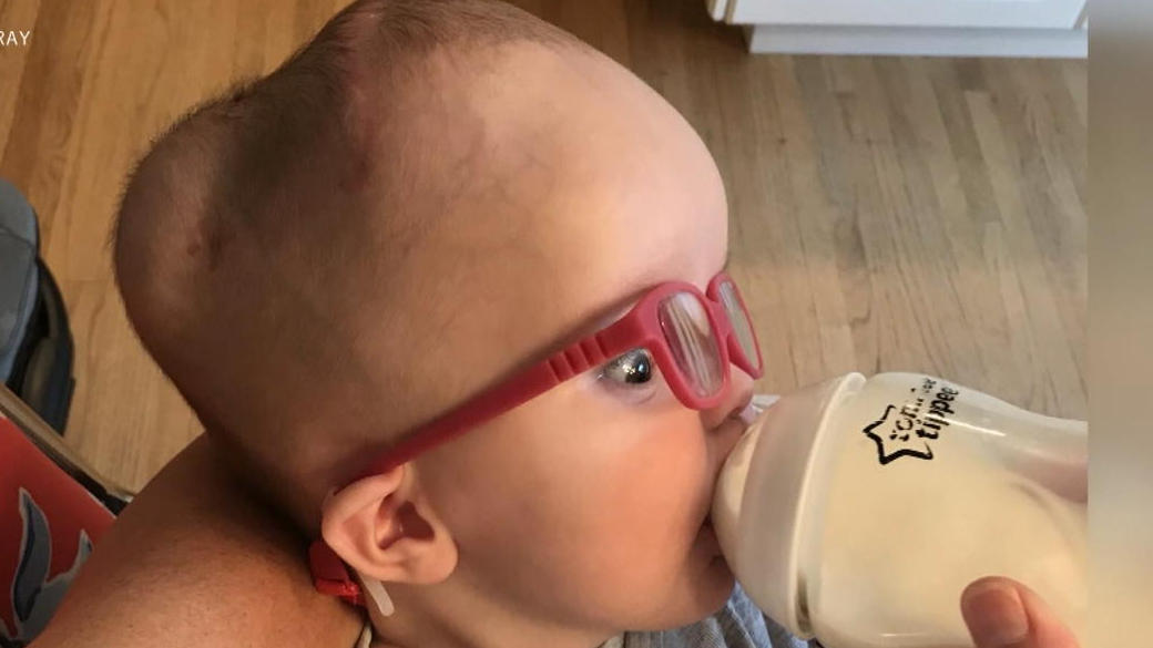 Baby Elizabeth überlebt seltenen Hirntumor So groß wie eine Grapefruit