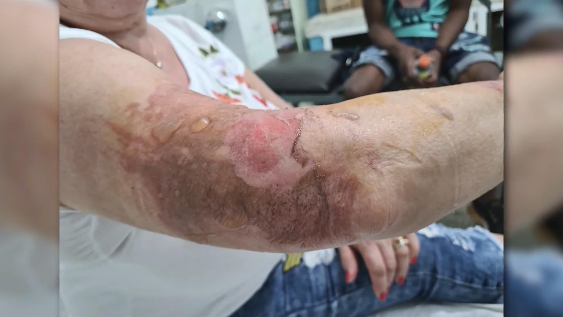Horror im Flugzeug Von Stewardess verbrüht