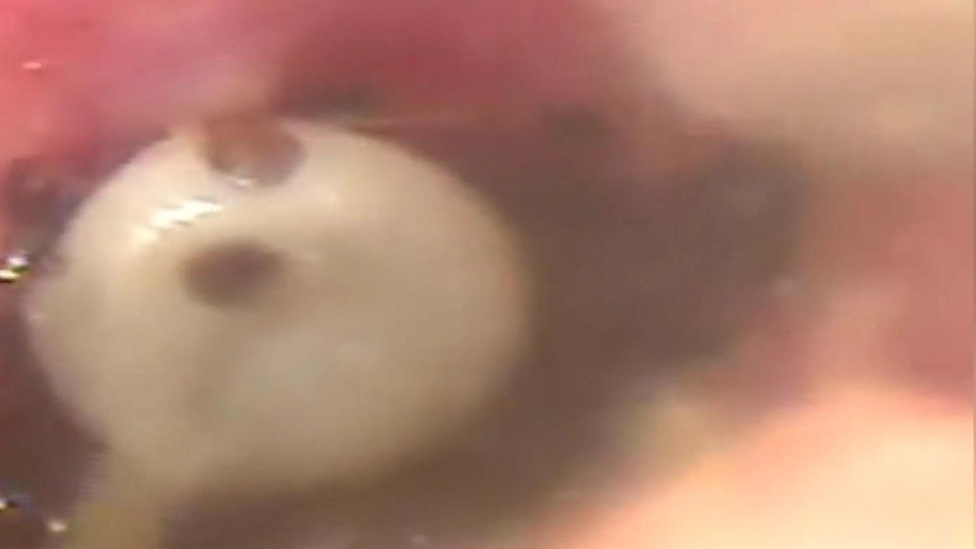 Arzt entfernt eingenistete Zecke aus Gehörgang Ekel-Fund im Ohr!