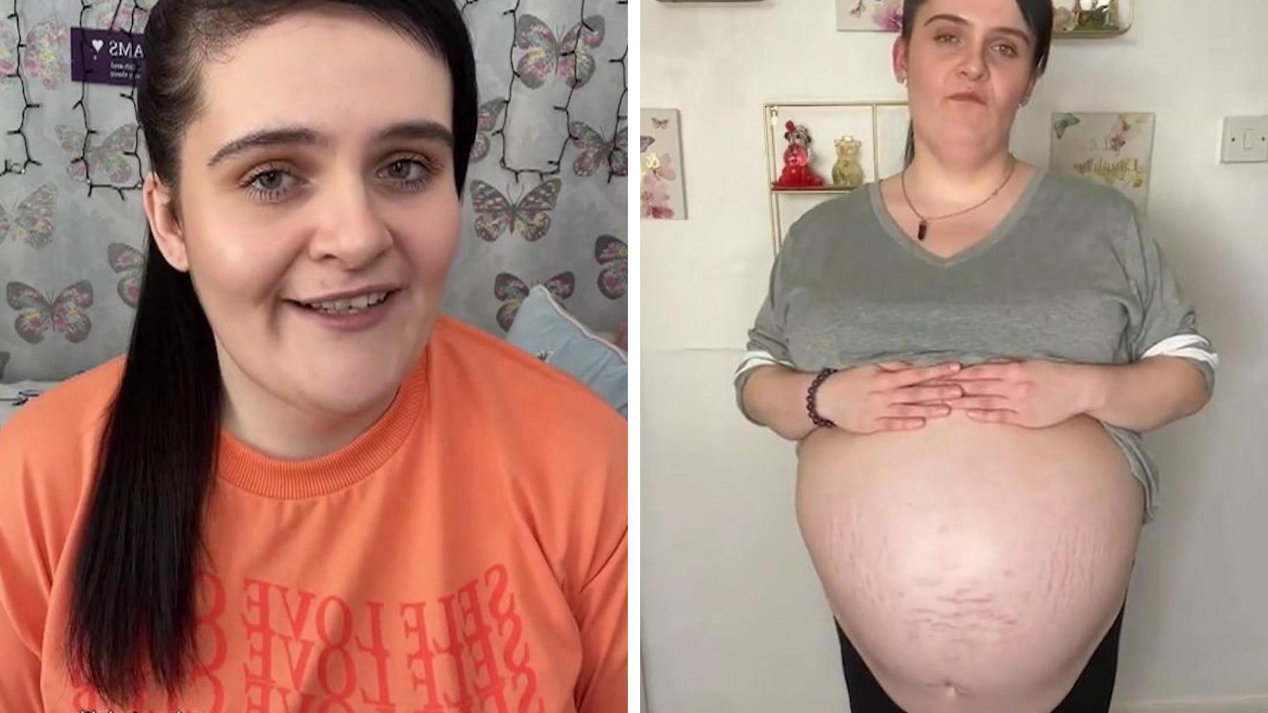 Frau hat 40-Zentimeter-Zyste im Bauch Menschen glauben: Sie ist schwanger!