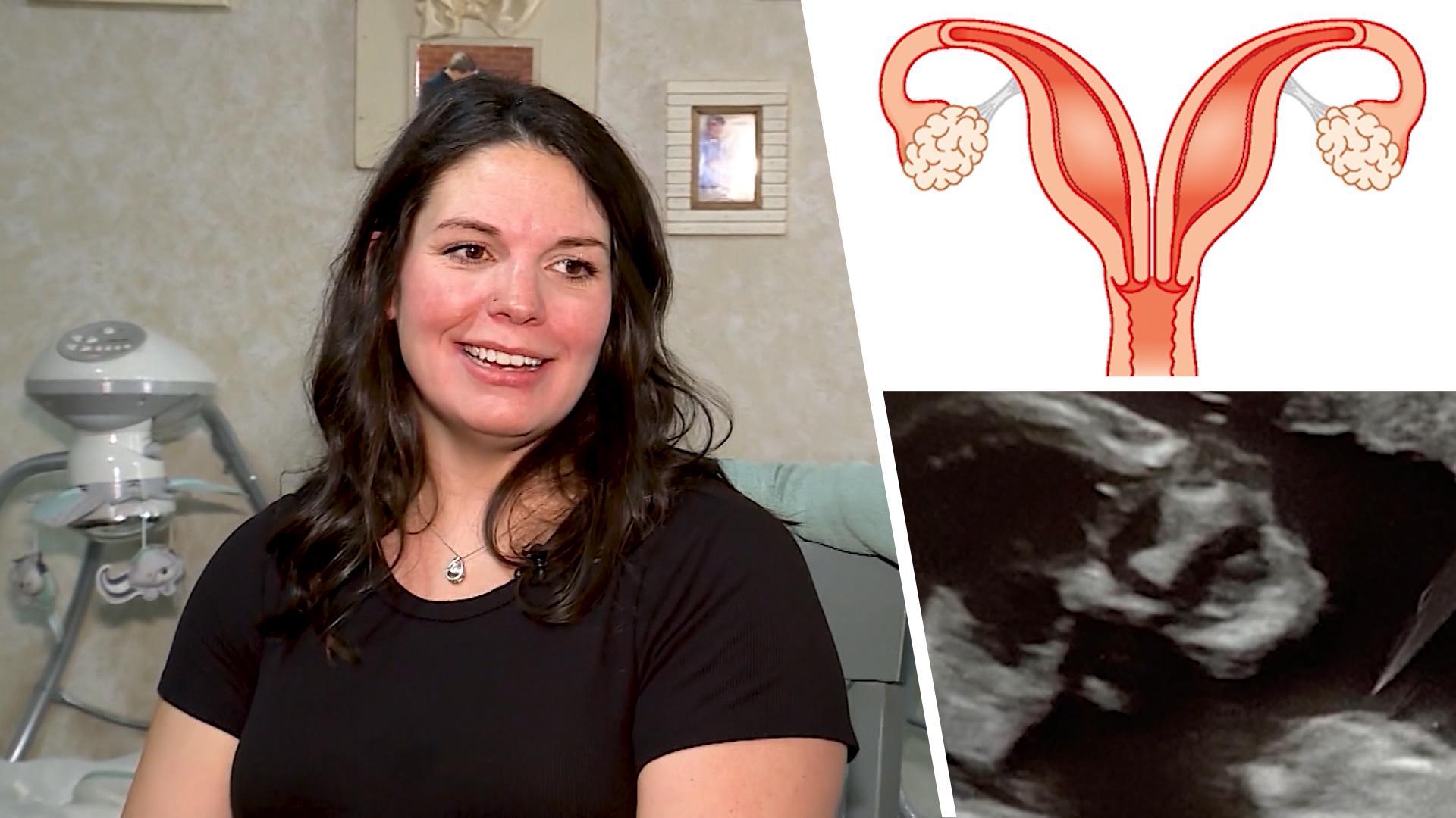 Frau hat zwei Gebärmütter - jetzt ist sie doppelt schwanger! Medizinisches Wunder
